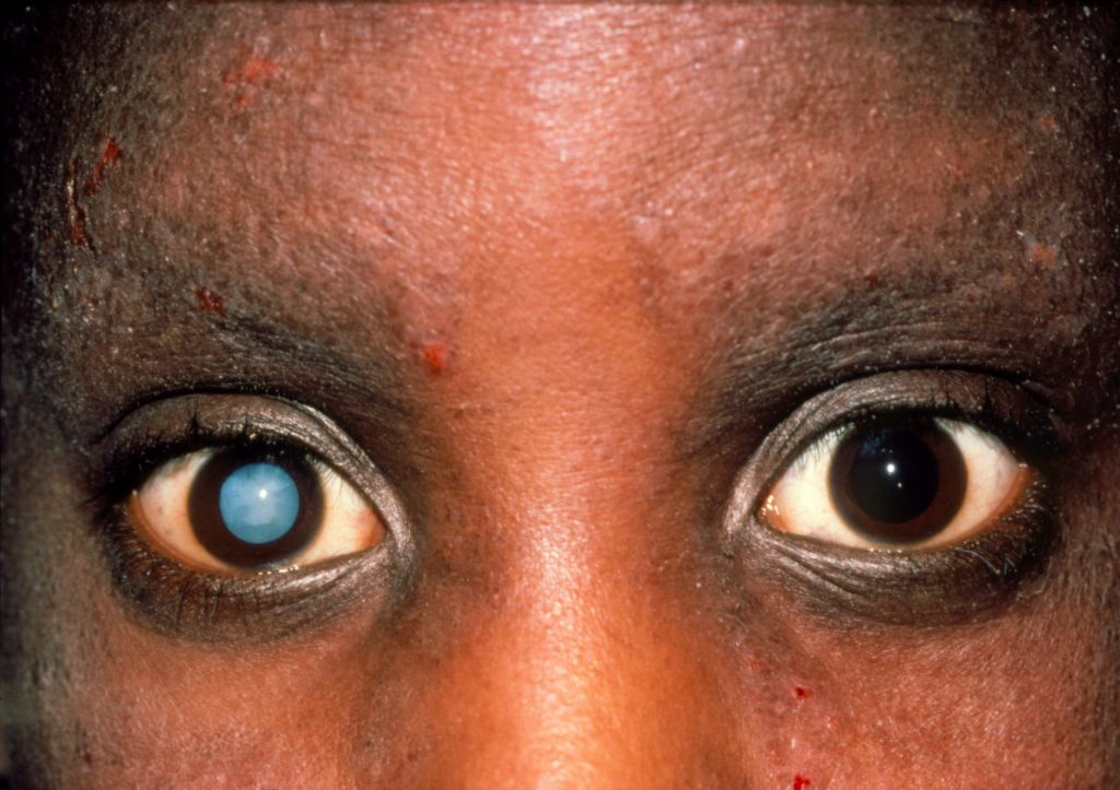 Cataracts 