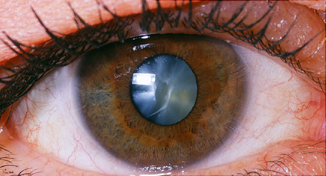 Cataracts